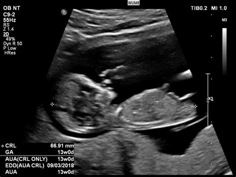 Ultrasound In Pregnancy Womens Ultrasound Melbourne Info Cafe