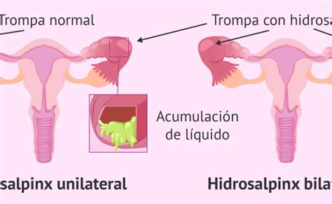 Hidrosalpinx Que Es Causas Sintomas Y Tratamiento Otosection