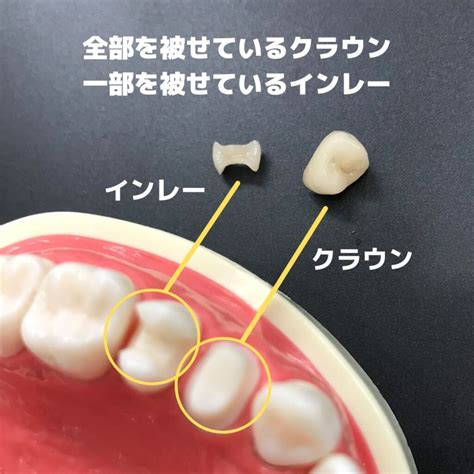 詰め物や被せ物が外れてしまったとき｜「くどう歯科医院」 三宮駅から徒歩6分の歯医者・歯科