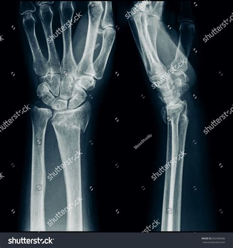 X Ray Wrist Lateral View