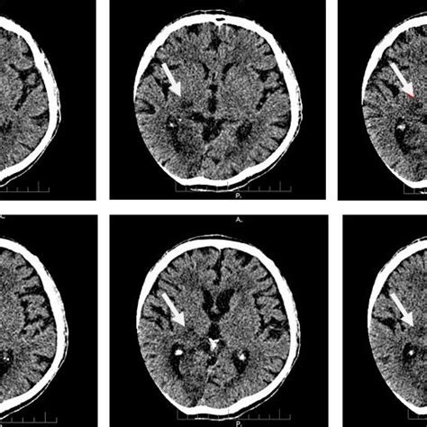 Patients Ct Scan Showing Hypodensity At The Level Of Right