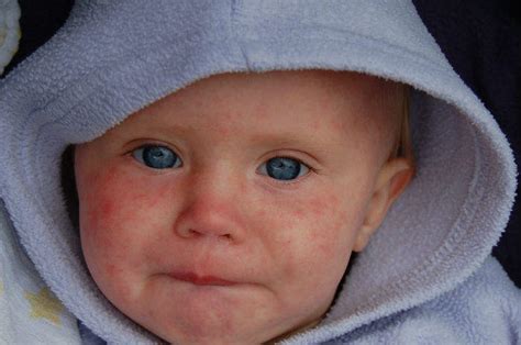 Allarme Morbillo Duemila Casi In Quattro Mesi