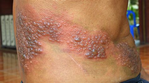 Early Symptoms Of Shingles