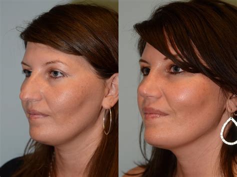 Revision Rhinoplasty In Houston