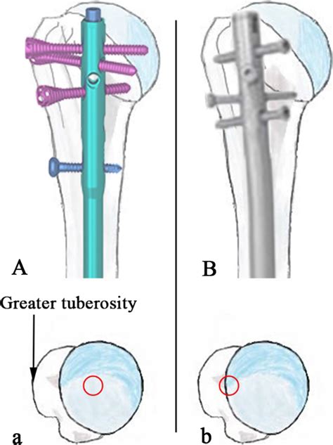 The Entry Point Of The Third Generation Intramedullary Nail Straight Download Scientific