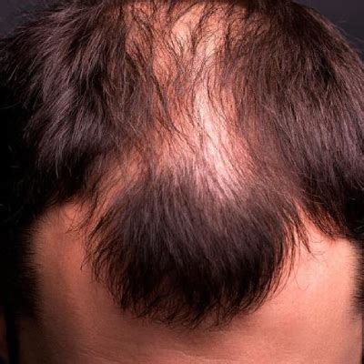 Hair Patch In Mumbai Know The Treatment Cost And Benefits Ahs India