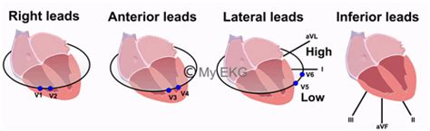 Correlation Between Heart Walls And Ekg Leads