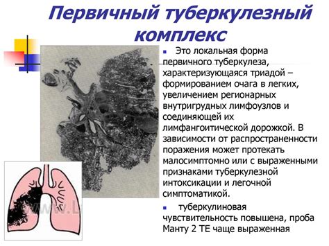 Туберкулез у детей первичный туберкулезный комплекс - фото презентация