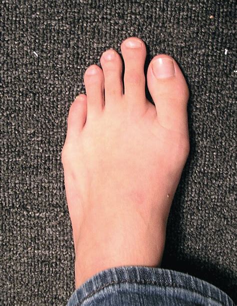 Morton's toe - Wikipedia