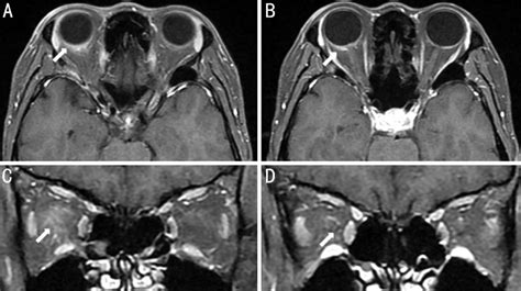 Magnetic Resonance Imaging Scans Of The Orbit With Contrast Infusion