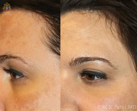 We Can Improve Your Melasma And Other Pigment Problems On Your Face