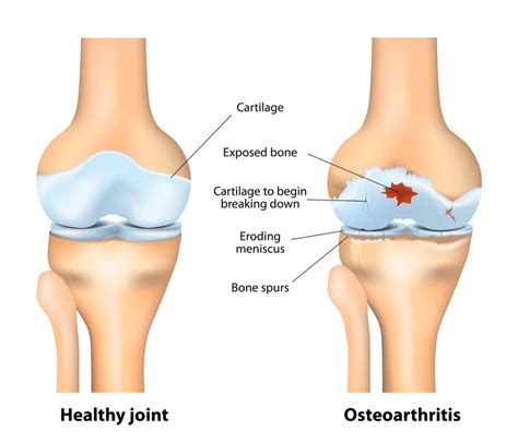 Knee Arthritis Osteoarthritis Orthopedic Knee Specialist