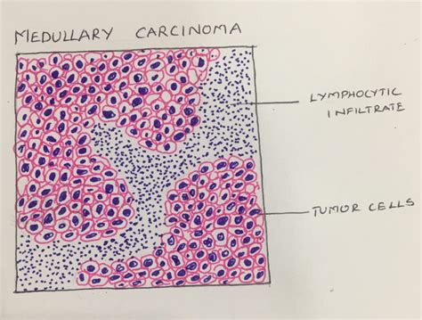 Medullary Carcinoma Breast Histopathologyguru