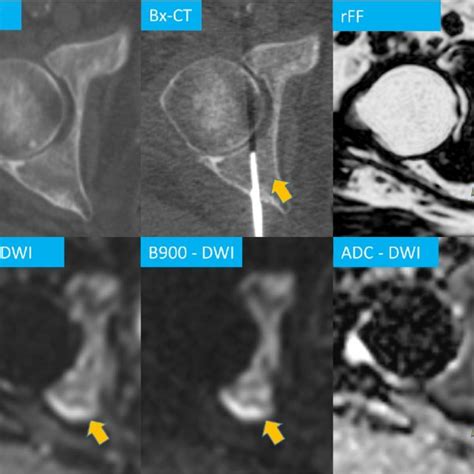 Multiparametric Mri Of A Right Acetabulum Metastasis In A 60 Year Old Download Scientific