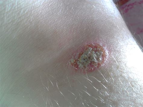 Появилась болячка на ноге фото - Вопрос дерматологу - 03 Онлайн