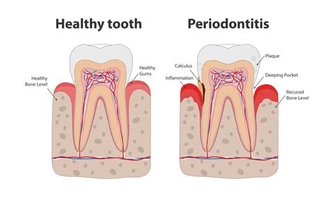 Modern And Effective Periodontal Treatments Austin Laser Dentist