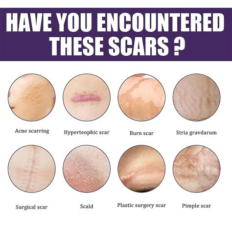 Scars Face Isle Of Man Scar Removal Scarring Isle Of Man