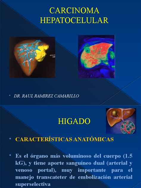 Carcinoma hepatocelular: aspectos clínicos, diagnósticos y de imagen ...