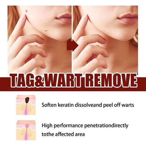 WipeOff Tags Moles Remover Fast Easy Effective In 5 Days Quick