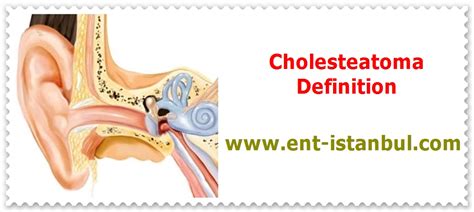 Cholesteatoma Definition Symptoms Complications And Treatment