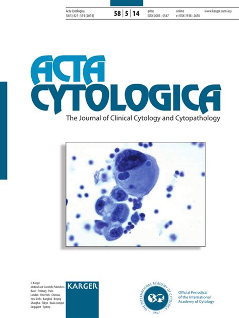 Fine Needle Aspiration Cytology Of Mammary Analog Secretory Carcinoma