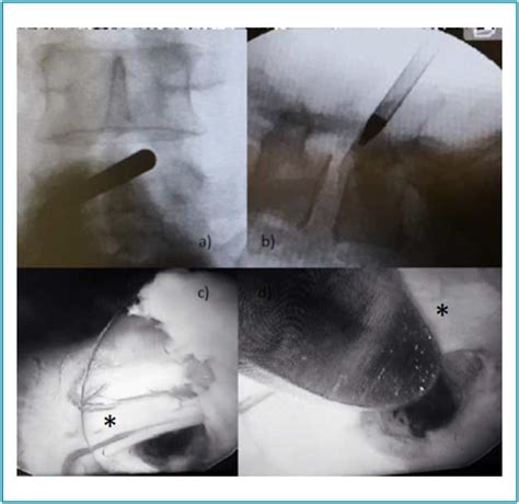 Scielo Brasil Comparison Of Two Endoscopic Spine Surgical