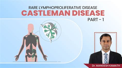 Rare Lymphoproliferative Disease Castleman Disease Part 1 Dr Mangesh Kamath Youtube