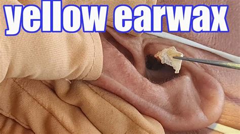 Yellow Earwax How To Clean Ears At Home How To Remove Earwax