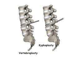 Kyphoplasty Vertebroplasty Tx Hospitals