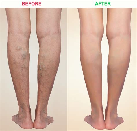 Winchester Radiologists Minimally Invasive Treatment Of Varicose Veins