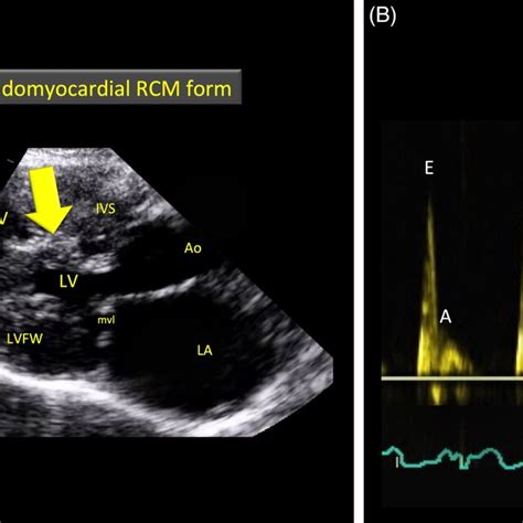 A And B Examples Of Echocardiograms Demonstrating The Left Atrial And