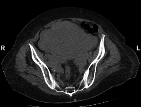 Ct Pelvis With Contrast Showing Heterogeneously Enhancing Mass Arising