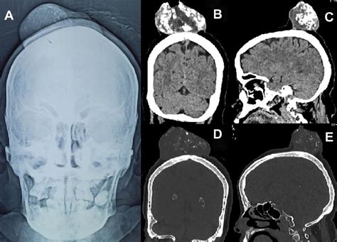 flecked calcifications  scalp tumors  cases  giant ulcerated