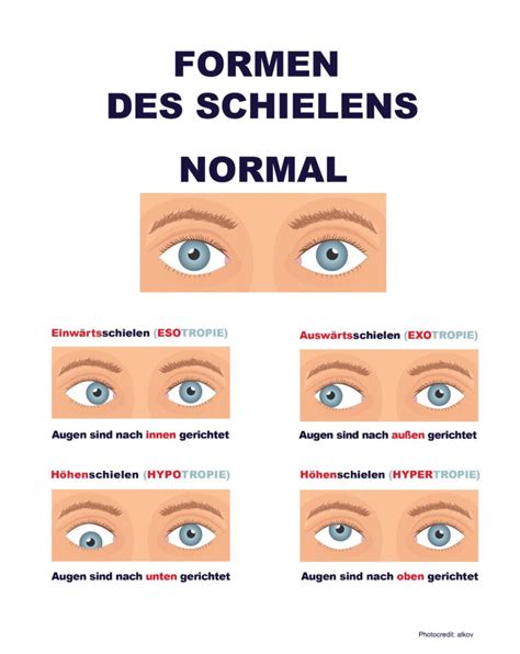 Schielen Strabismus Augenarzt Wien Vienna Alle Kassen