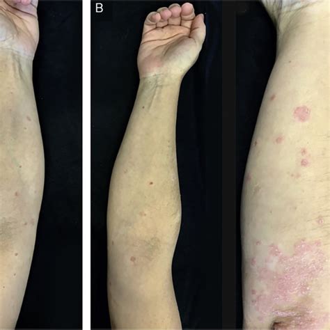 Guttate Psoriasis And Chronic Plaque Psoriasis Flare Case 2 A Download Scientific Diagram