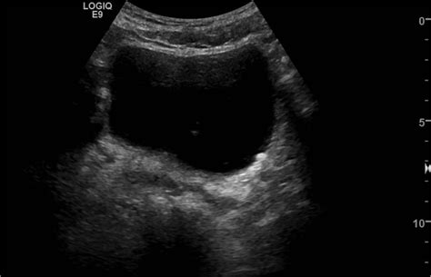 Renal Bladder Ultrasound