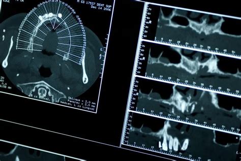 Guided Implant Surgery – Advanced Implants & Periodontics