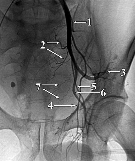 Diagram External Iliac Artery Diagram Wiringschema