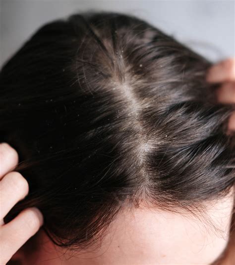 Scalp Build Up: Definition, Causes, And How To Get Rid Of, 47% OFF