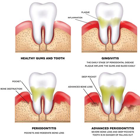 Periodontal Disease Treatment at Pascack Valley Dental Practice