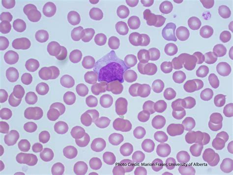 Reactive Lymphocyte - 1 | ERA