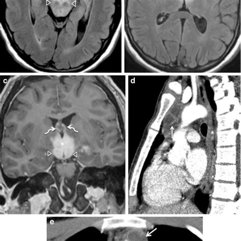 Thymic Germinoma In A Year Old Man Presenting With Mental Status