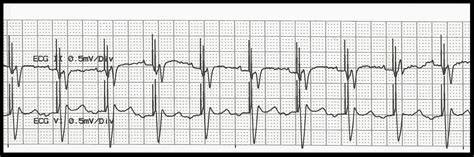 Float Nurse Various Biventricular Paced Rhythms