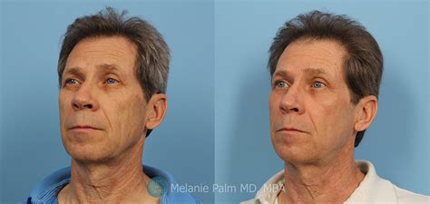 Co2 Laser Resurfacing Peel Before And After San Diego