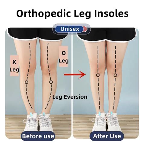 Palmilhas Ortop Dicas De Silicone Para P S Corre O Valgus Tipo Perna O