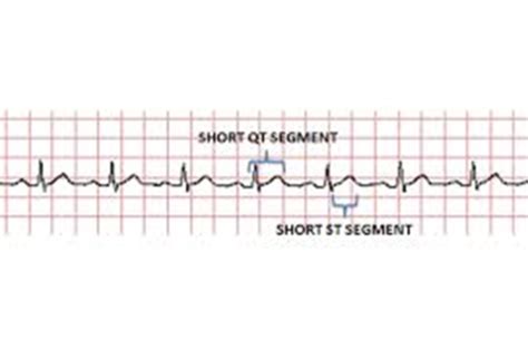 Med Diagnostics II EKG Misc Review Flashcards Quizlet