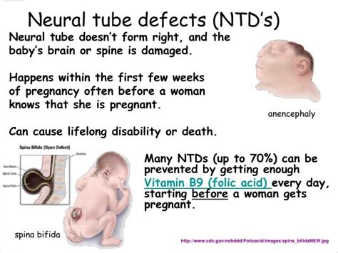 Ppt Neural Tube Defects Ntds Powerpoint Presentation Free