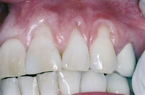 Gum Recession Gum Grafting Periodontist Periodontal Surgery