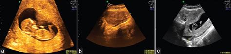 Successful Laparoscopic Management Of Heterotopic Pregnancy