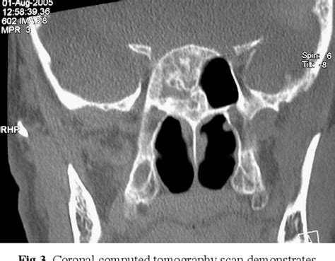 Figure 3 From Sphenoid Sinus Fungal Balls Semantic Scholar